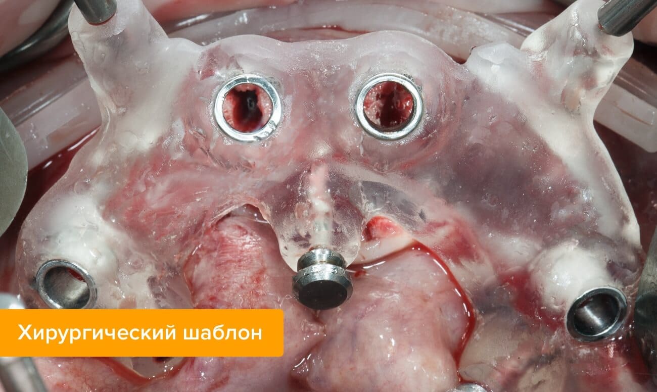 Фото хирургического шаблона