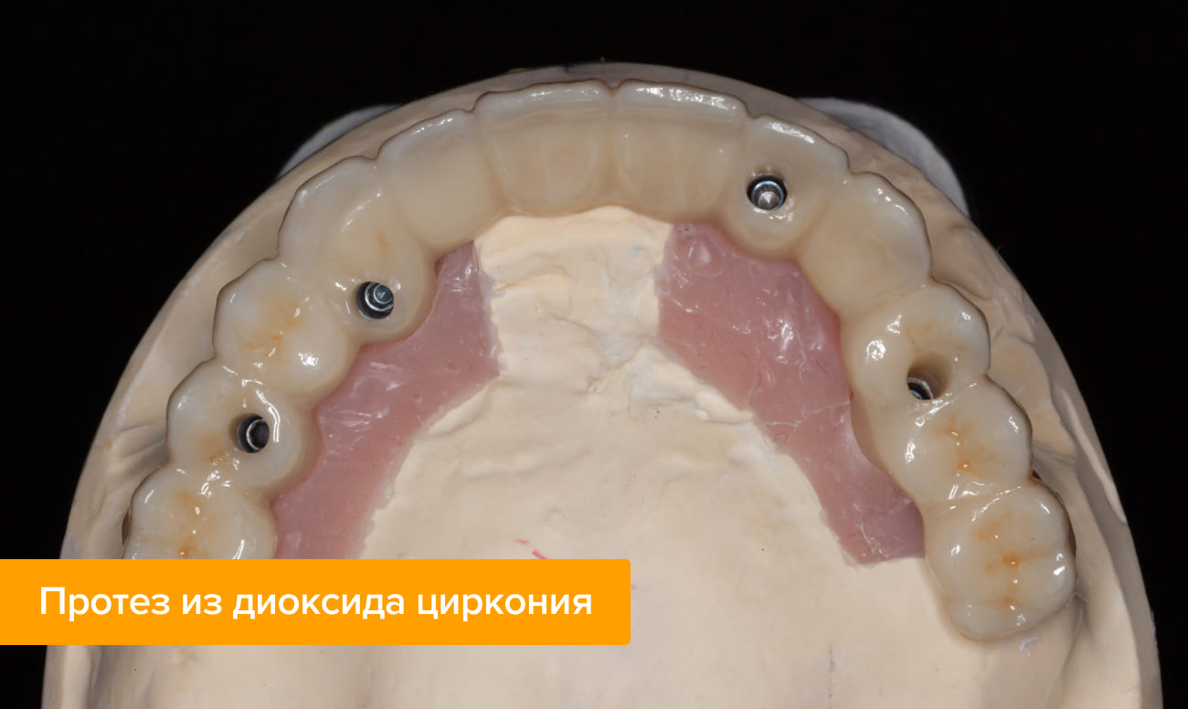 Фото протеза из диоксида циркония